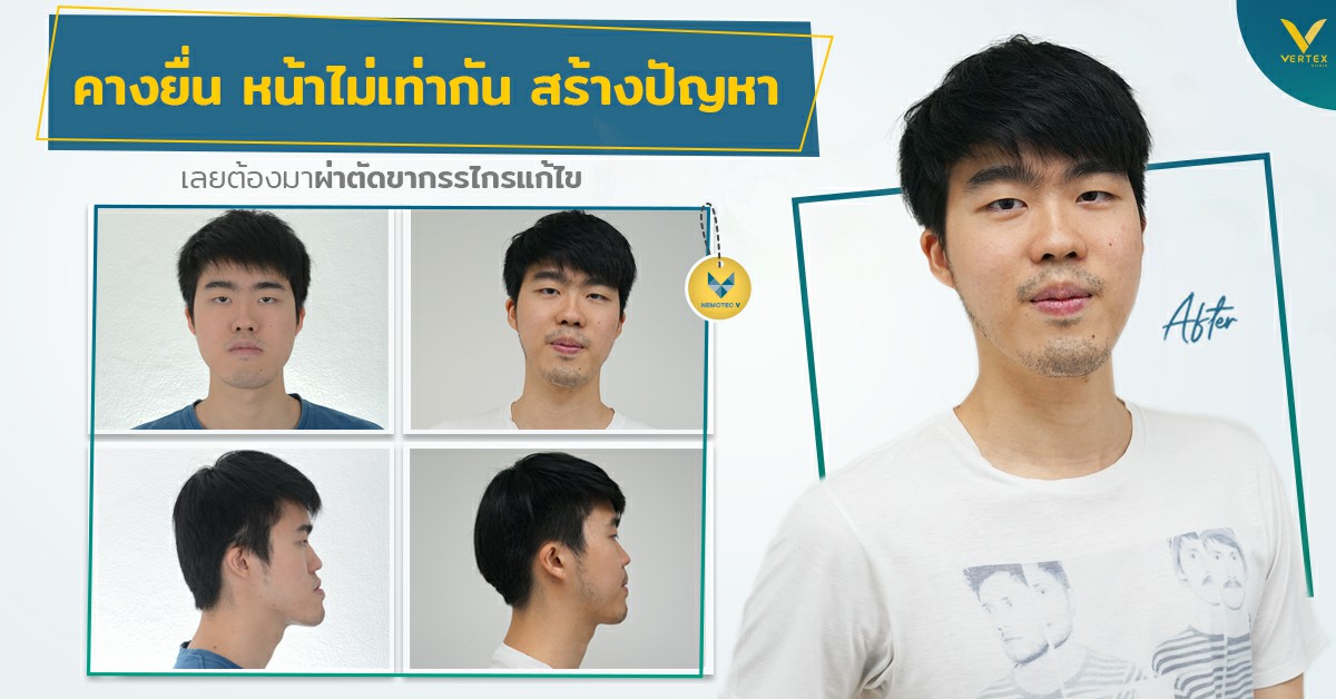 รีวิวผ่าขากรรไกร] คางยื่น ฟันไม่สบกัน หน้าไม่เท่ากัน ผ่าขากรรไกรแก้ไข