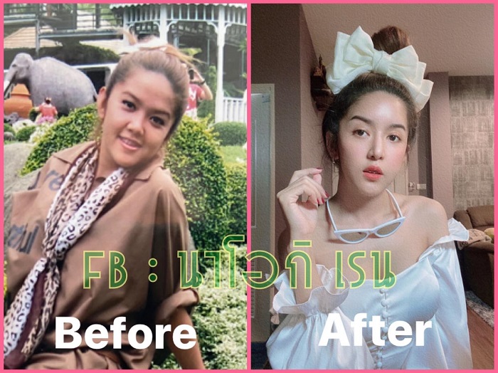 คุณนัส ภาพก่อนทำและหลังทำผ่าตัดขากรรไกรเปลี่ยนโครงหน้า