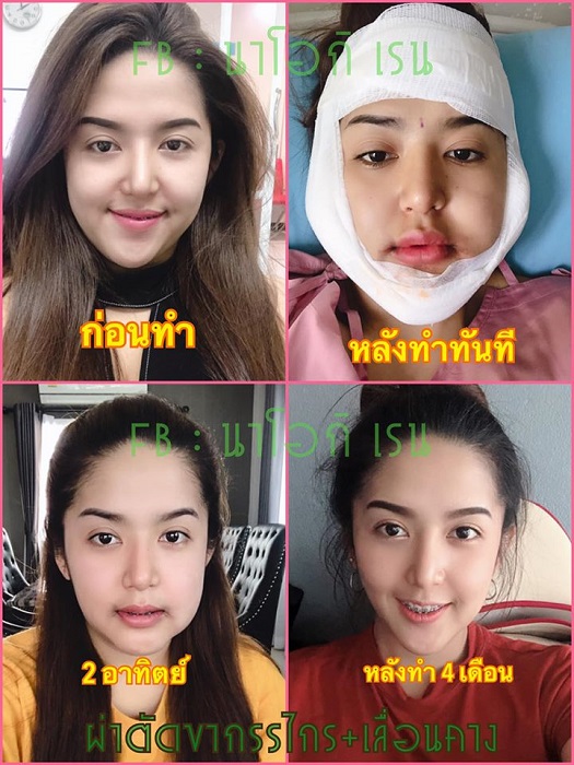 ภาพก่อนและหลังผ่าตัดปรับโครงหน้าผ่ากรรไกร