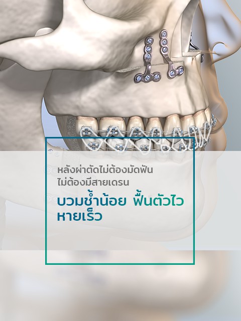 ผ่าขากรรไกรไม่มัดฟัน ผ่าตัดโครงหน้า ฟันไม่สบกัน ผ่าขากรรไกรที่ไหนดี