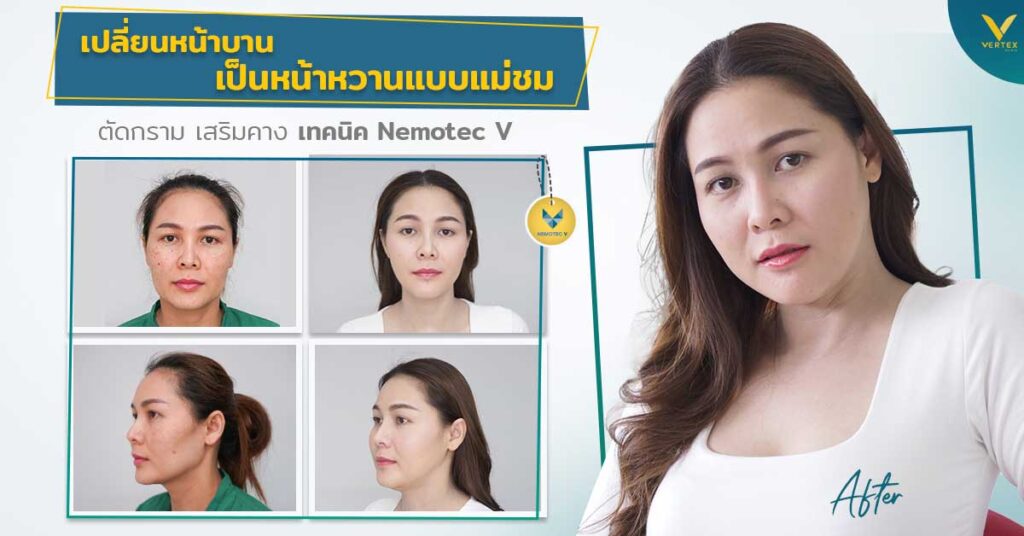 รีวิวตัดกราม เหลากรามที่ไหนดี ผ่าตัดลดกรามที่ไหนดี ผ่าตัดมุมกราม