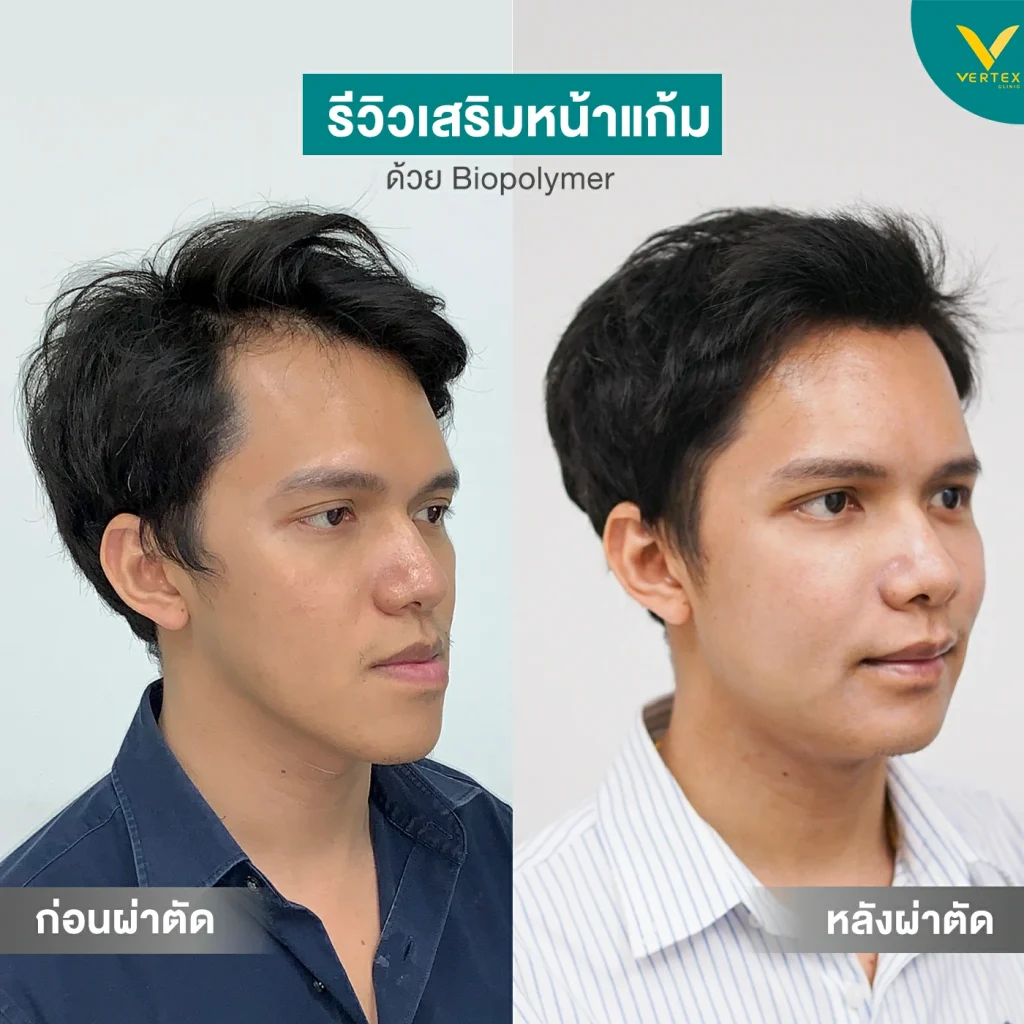 แก้มตอบ แก้ยังไง? นวัตกรรมใหม่รักษาแก้มตอบแบบถาวร! ด้วย Biopolymer