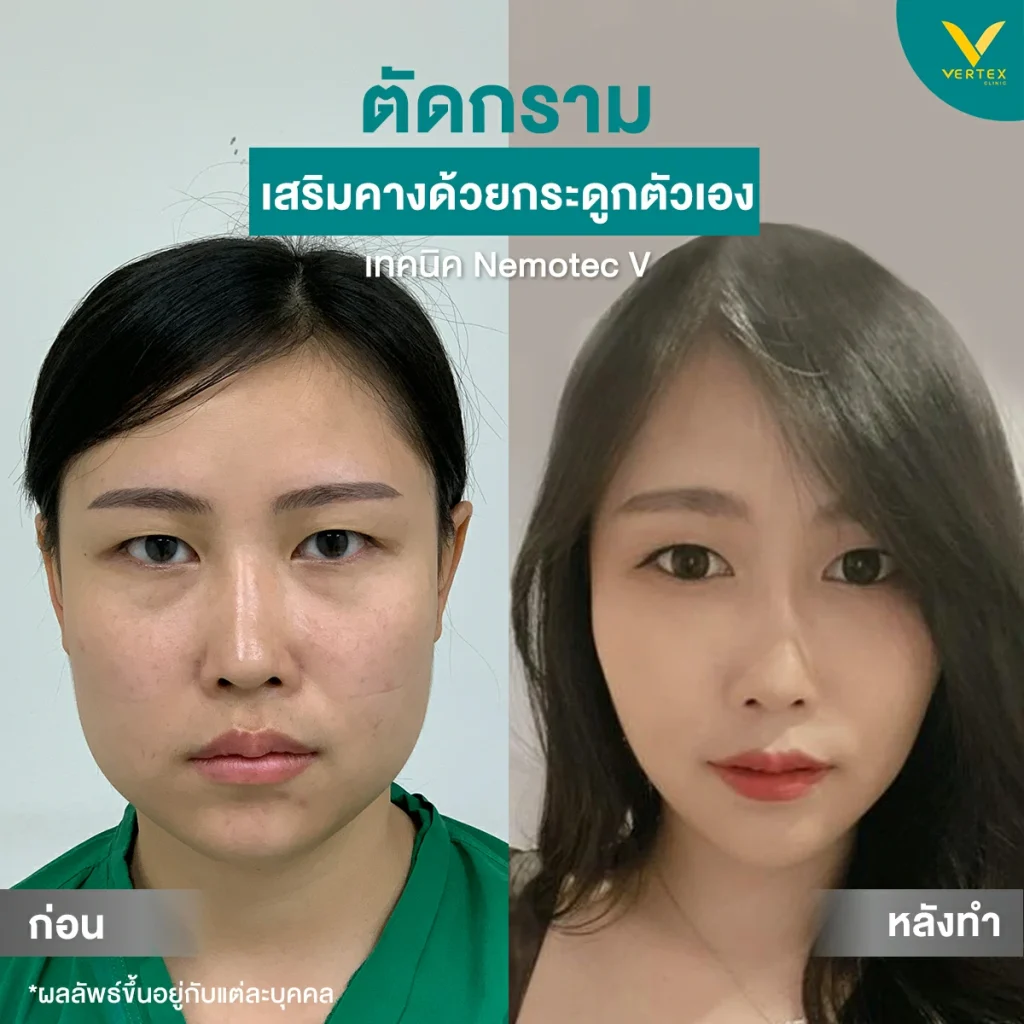 Before & After ตัดกราม