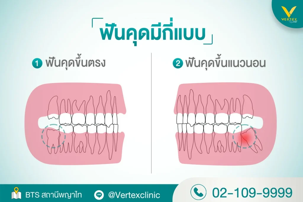 ฟันคุด จะรู้ได้อย่างไรว่าต้องผ่าฟันคุด หรือ ถอนฟันคุด  วิธีดูแลตัวเองหลังจากผ่าฟันคุด