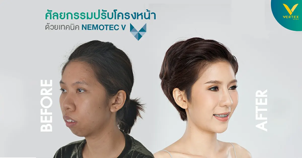 ผ่าตัดโครงหน้า โครงหน้าเบี้ยว โครงหน้าใหญ่ รีวิวปรับโครงหน้าที่ไหนดี