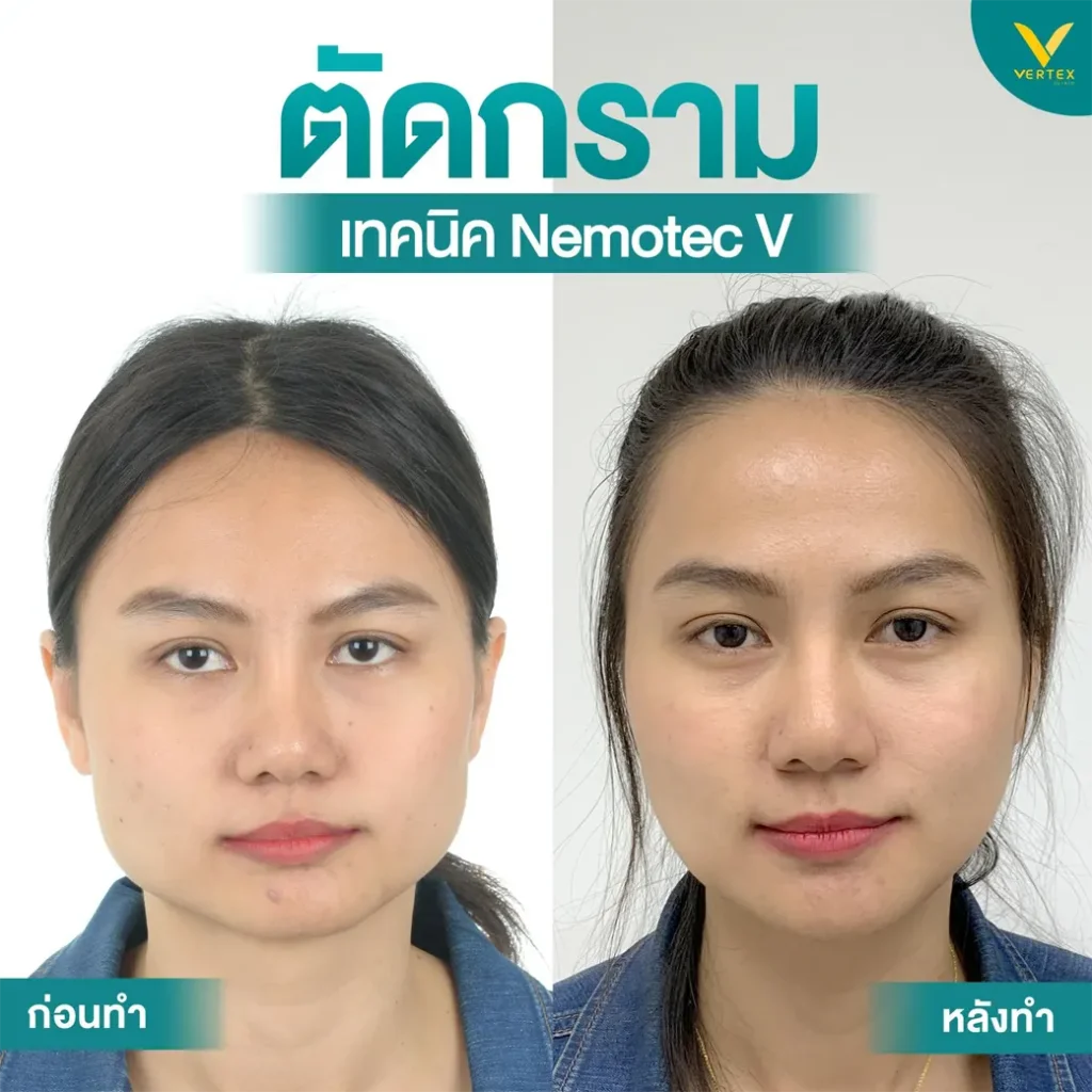 ตัดกราม เหลากราม ศัลยกรรมกราม ด้วย เทคนิค Nemotec V